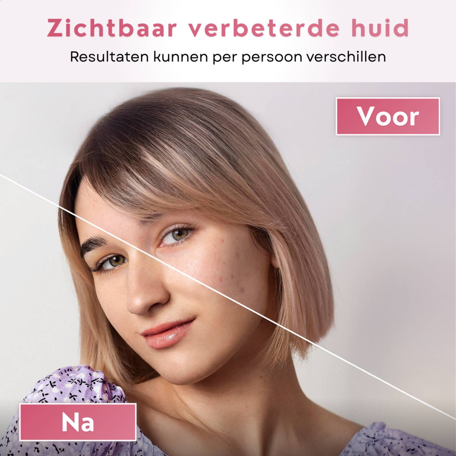 Voor- en na-afbeelding van een gezicht met zichtbaar verbeterde huidtextuur.